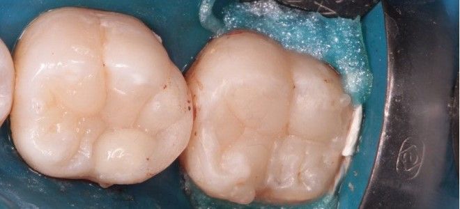 светоотверждаемая пломба светоотверждаемая пломба