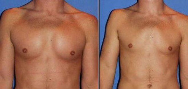 синдром титце осложнения синдром титце осложнения