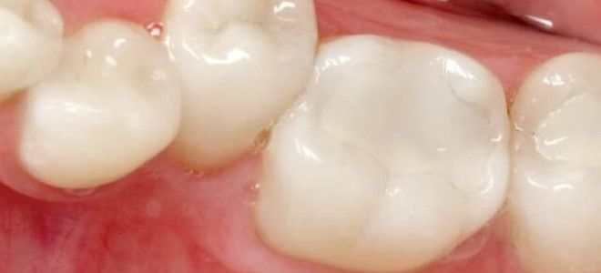 стеклоиномерная пломба стеклоиномерная пломба