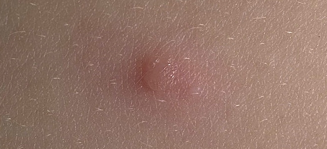 как передается ветрянка через третьих лиц