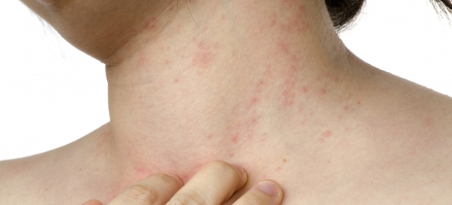 красные прыщи на теле