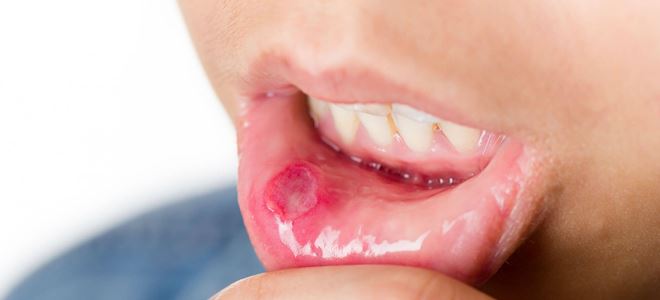 красный прыщ на губе