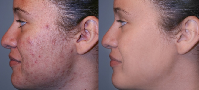 лечение роаккутаном