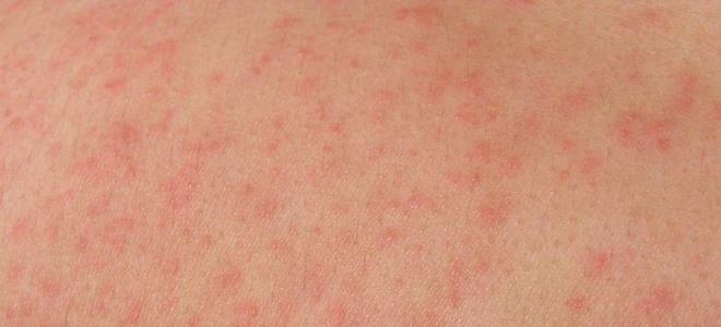 мелкие прыщи на теле
