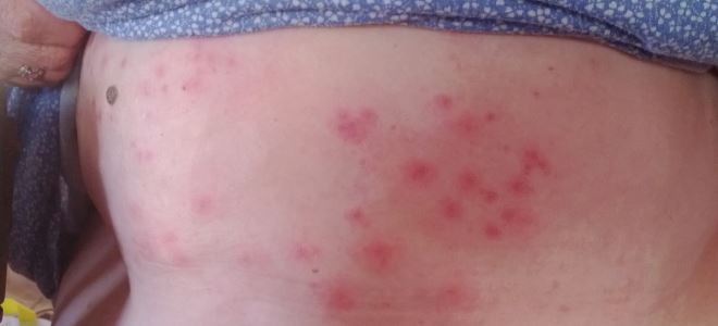прыщи на животе