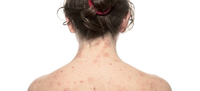 прыщи по всему телу