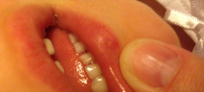 твердый прыщ на губе