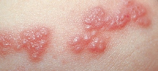 водянистые прыщи на теле