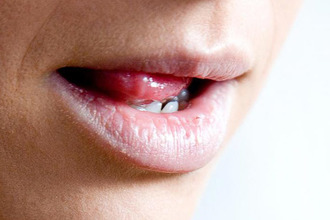 Сухость во рту Сухость