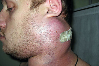 Лимфаденопатия лимфаденопатия