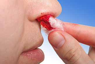 Носовые кровотечения Кровь из носа