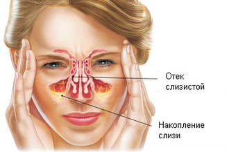 Симптомы хронического синусита Симптомы