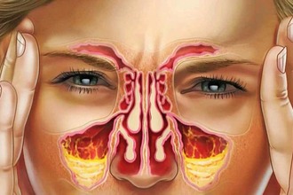 Двусторонний гайморит Двусторонний гайморит