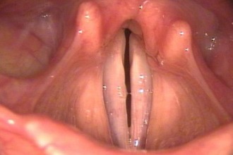 Рубцовый стеноз гортани удушье