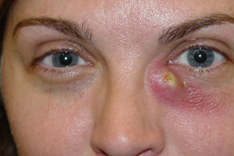 Острый дакриоцистит с фистулой дакриоцистит