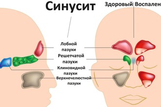 Виды воспаления пазух Виды