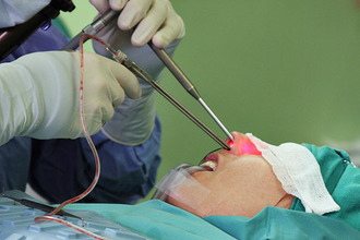 Пункция гайморовой пазухи Пункция