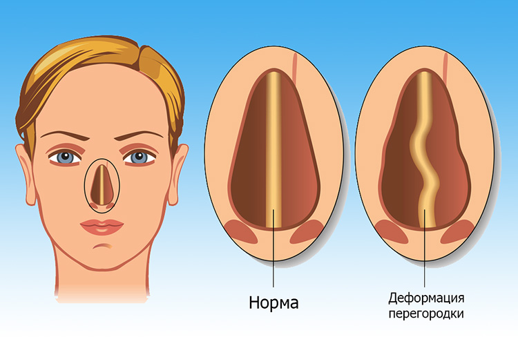 Искривление носовой перегородки Искривление перегородки