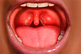 Фарингит у ребенка Фарингит у детей