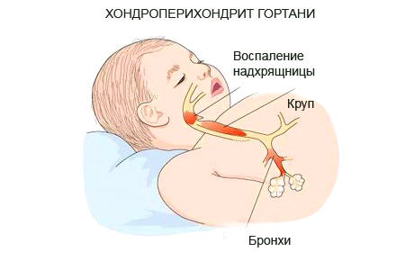 Причиной состояния могут стать инфекции Хондроперихондрит