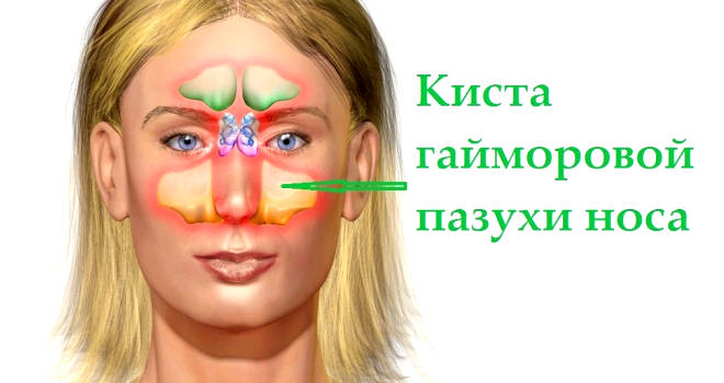 Симптомы могут свидетельствовать о наличии кисты гайморова пазуха киста