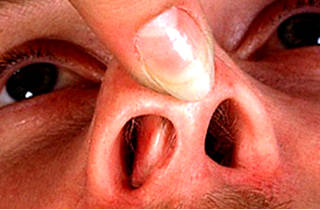 Спайки могут стать причиной затрудненного питания спайки устранить