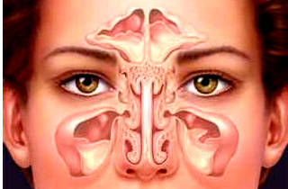 Распознать нарушения можно по некоторым особым признакам Синехии носа