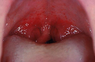 Сыпь в горле Сыпь в горле