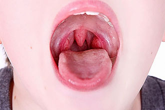 Ангинозное воспаление у ребенка Симптомы