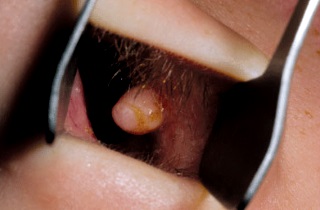 Полипозный пансинусит появляется из-за хронической формы этого заболевания Что такое пансинусит