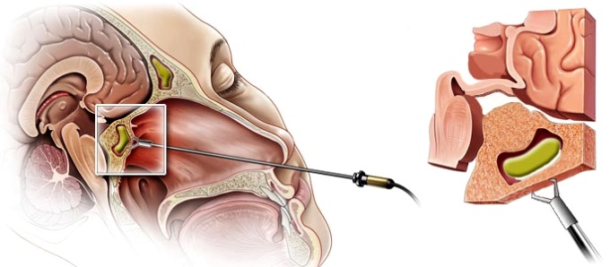 При гнойном воспалении пазухи носа проводится пункция Лечение пансинусита