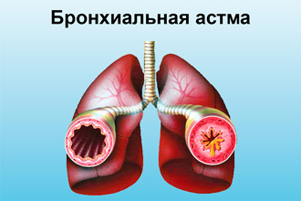 Бронхиальная астма как последствие трахеита Бронхиальная астма