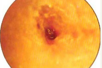 Диффузный наружный отит Диффузный наружный отит