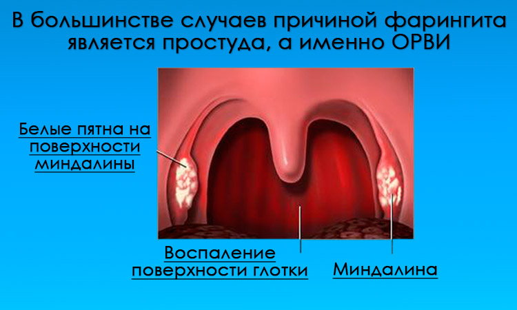 Признаки фарингита Фарингит