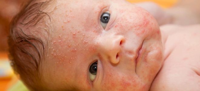 Акне у новорожденных Акне у новорожденных