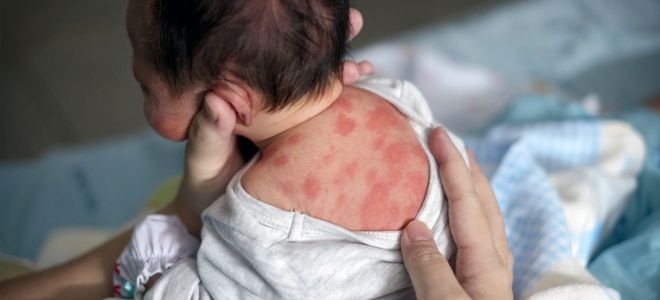 Токсическая эритема у детей Токсическая эритема у детей