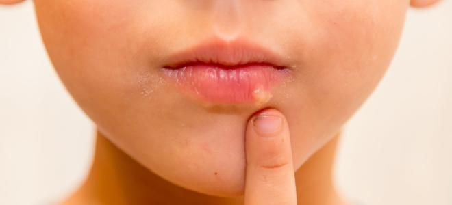 Герпесная сыпь у детей раз Герпесная сыпь у детей раз