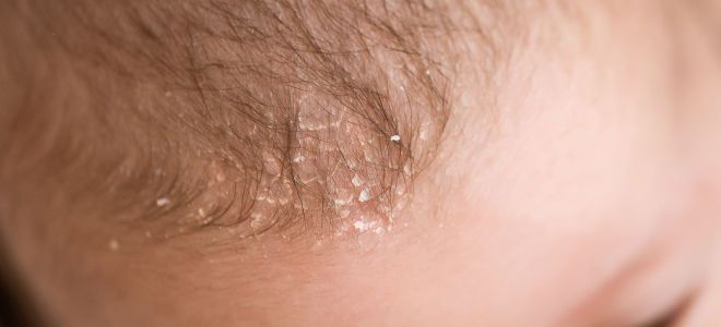 Себорея у детей Себорея у детей