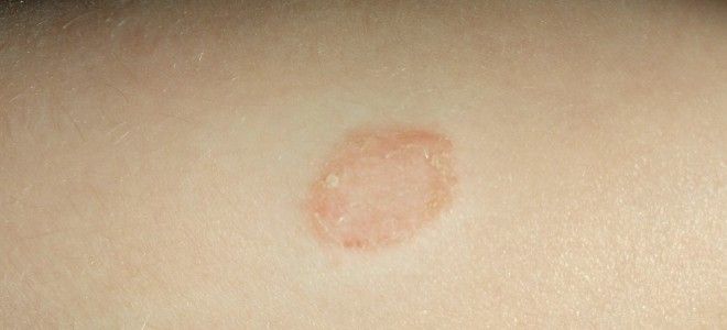 Лишай у детей раз Лишай у детей раз