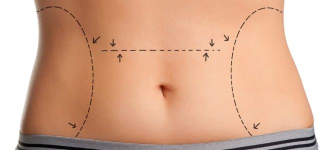 Абдоминопластика виды и особенности операции Абдоминопластика виды и особенности операции