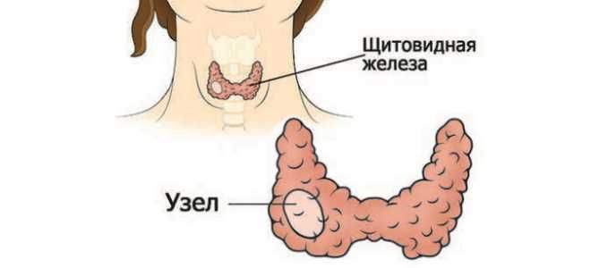 аутоиммунный тиреотоксикоз аутоиммунный тиреотоксикоз