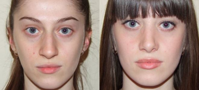 чем хорош плазмолифтинг чем хорош плазмолифтинг