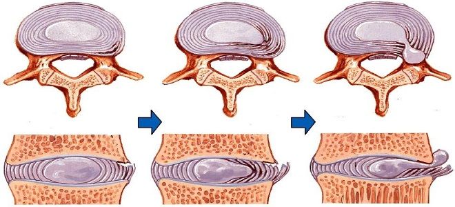 фото1 диффузная протрузия диска