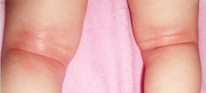 экссудативный диатез фото экссудативный диатез фото