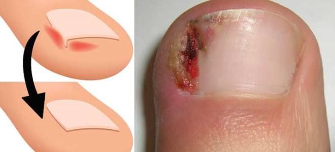 гранулема ногтя причины гранулема ногтя причины