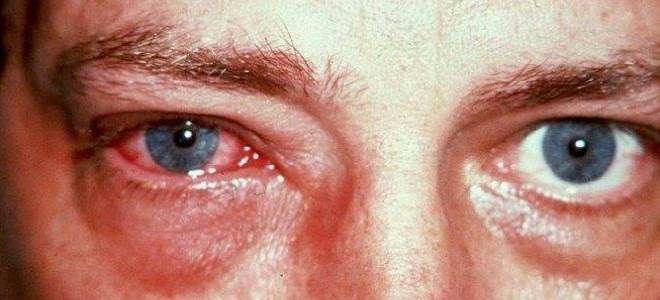 фото1 хламидиоз глаз симптомы