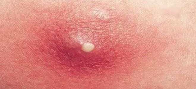 ихтиоловая мазь при фурункулах ихтиоловая мазь при фурункулах