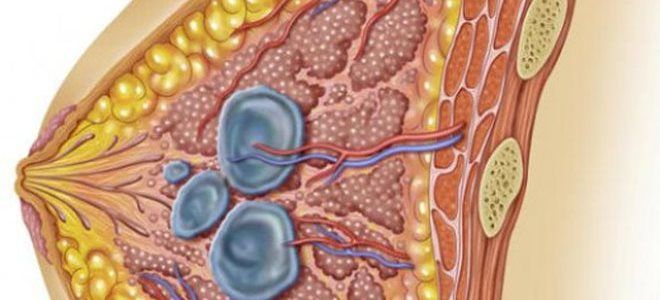 киста в груди киста в груди