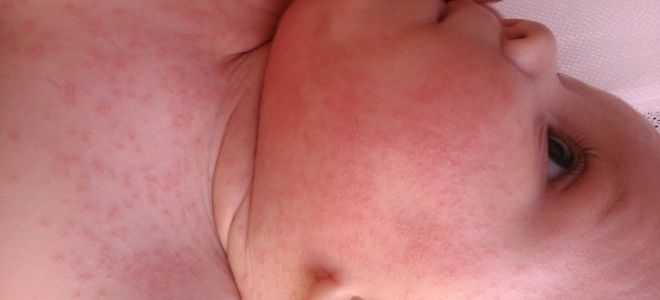 Потница у детей Потница у детей