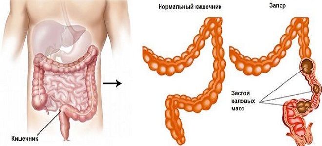 фото1 применение гутталакс